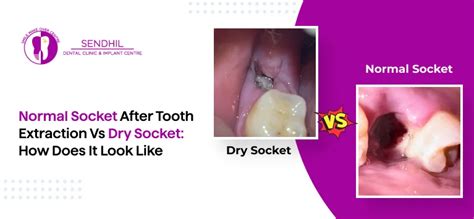 Tooth Socket After Extraction 的图像结果