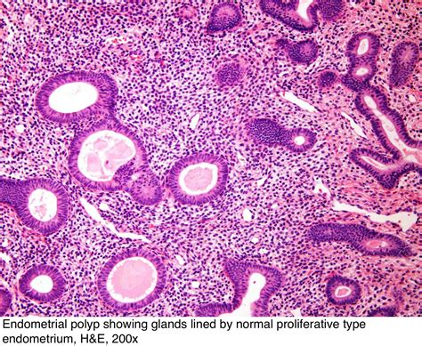 Pathology Outlines - Endometrial polyp