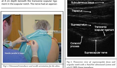 Figure 1 - Ultrasound-guided suprascapular nerve block