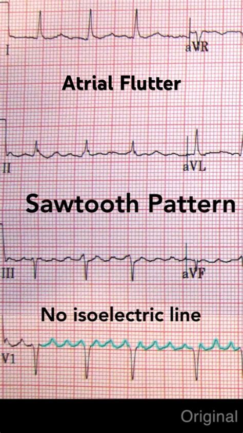Image result for Atrial Flutter ECG Pattern