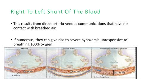 Hepato pulmonary syndrome | PPTX