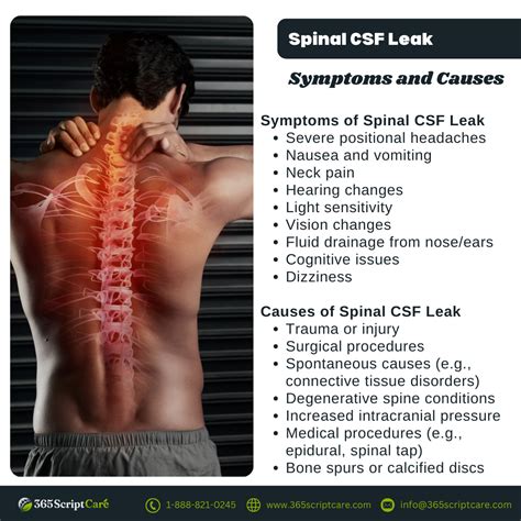 Spinal csf leak sign and symptoms – Artofit