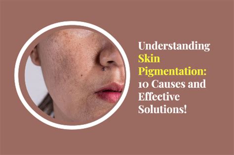 10 Causes of Skin Pigmentation and How to Reduce It? – SkinQ