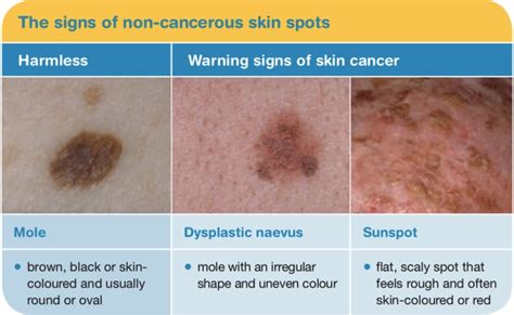 Types Skin Cancer Signs 的图像结果