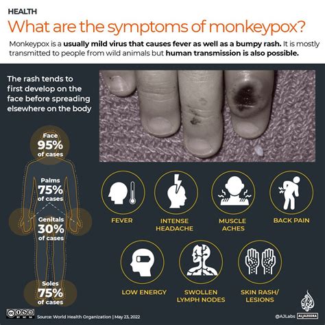 Monkeypox Virus - Understanding Its Origins, Symptoms, and Prevention ...