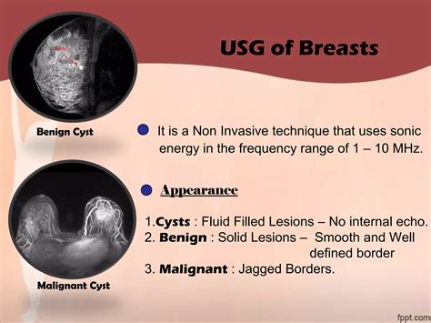 Investigations of ca breast | PPT