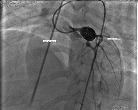 Giant coronary artery aneurysm following Kawasaki disease: follow-up by various cardiac imaging ...