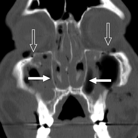 How to Simplify the CT Diagnosis of Le Fort Fractures | AJR