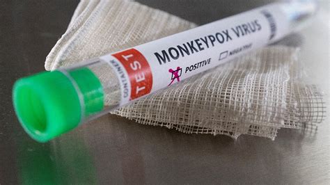 Centre issues guidelines for management of Monkeypox: Details here