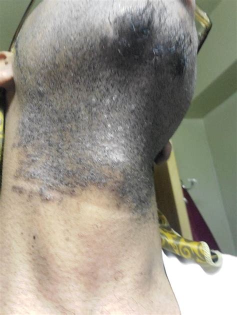 Natural Razor Bumps & Ingrown Hair Acne Treatment dark Beard Marks Remover - Etsy