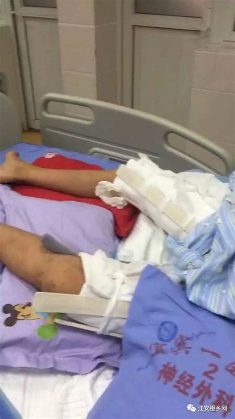 悲剧！江安11岁学生从4楼坠下摔成重伤，全身多处骨折，父母哭惨了-搜狐