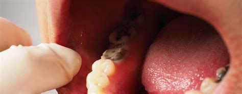 Wisdom Tooth Cyst Removal 的图像结果