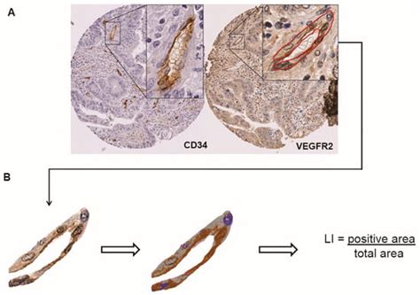 The Prognostic Value of the Combination of Low VEGFR-1 and High VEGFR-2 ...