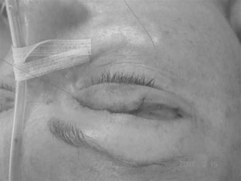 Image result for Surjet Simple Intradermique