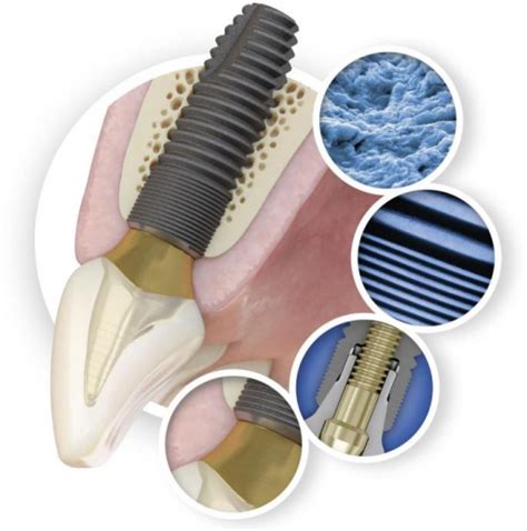 牙科患者福音 Astra种植系统锥形封闭连接设计 让种植牙更美观凤凰网山东_凤凰网