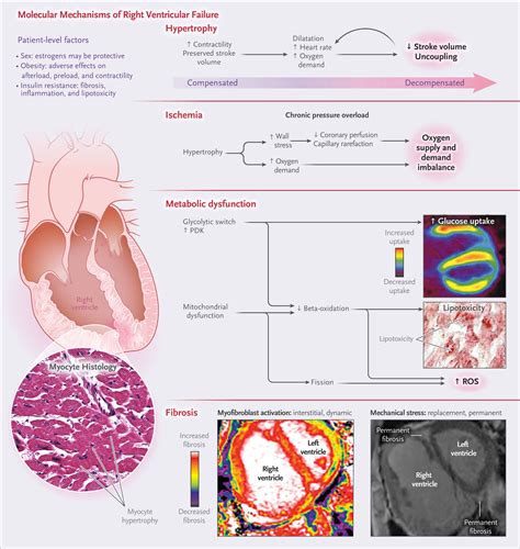Right Ventricular Failure | NEJM