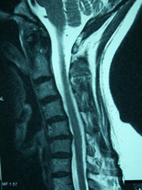 Anterior Cervical Fusion - Reno Orthopedic Center