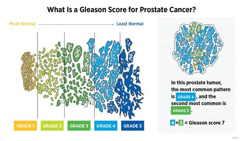 What Is a Gleason Score for Prostate Cancer? | Blog | AACR