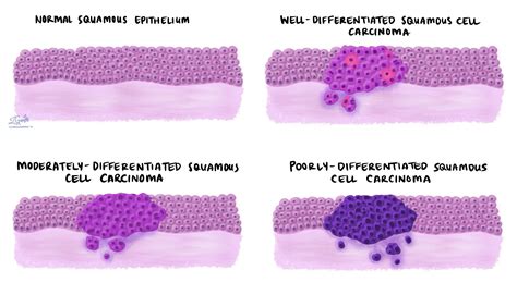 Tlaleho ea hau ea lefutso bakeng sa squamous cell carcinoma ea letlalo | Tlaleho ea MyPathology