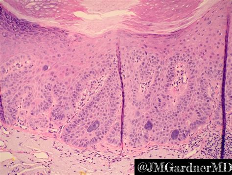 Actinic Keratosis Histology Histopathological Subtyping Of Actinic