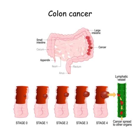 स्टेज 3 कोलोरेक्टल कैंसर (Stage 3 Colorectal Cancer) के बारे में जानें ...