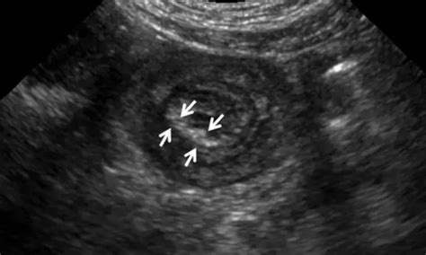 POCUS helpful for differentiating intussusception in pediatric patients ...