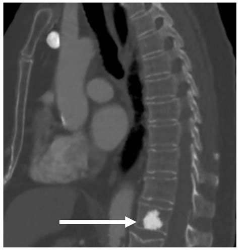 Primary Benign Neoplasms of the Spine
