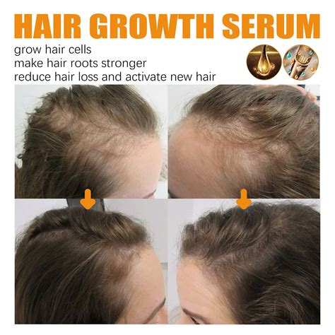 Allurium Beauty Hair Growth Serum Black Women, Anti India | Ubuy