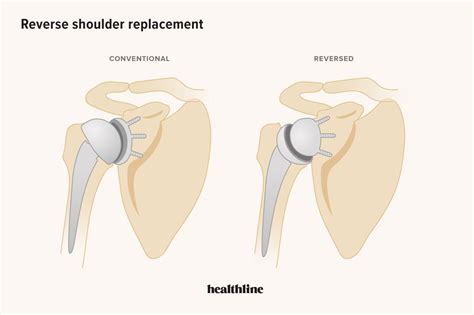 Image result for Shoulder Replacement Exercises