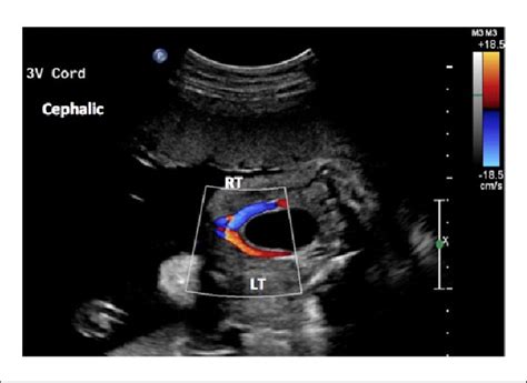 Bildergebnis für velamentous umbilical cord ultrasound
