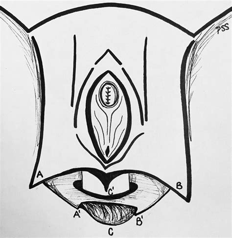 Penile Inversion Vaginoplasty Technique - Urologic Clinics