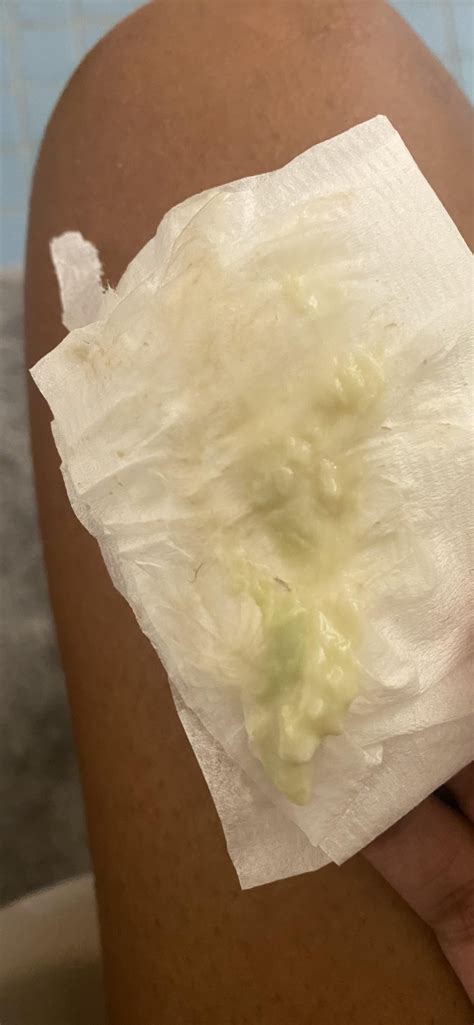 Lime Green Discharge From Ear at Eddie Randolph blog