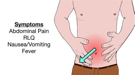Appendicitis Pain Appendicitis: Symptoms And Causes HealthXchange