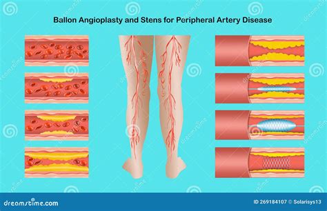 Angioplasty Diagram For Peripheral Artery Disease Stock Image | CartoonDealer.com #356623663