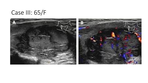 Parathyroid gland Ultrasound scan presentation | PPTX