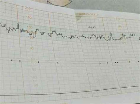 胎心监护报告图解析：胎儿监护中各类型减速的特点 - 知乎