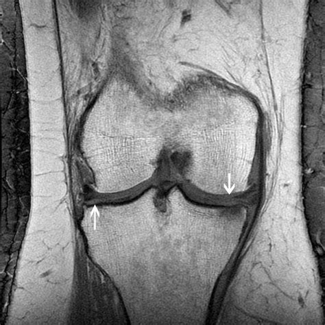 3.0-T MRI of Meniscal Tears | AJR