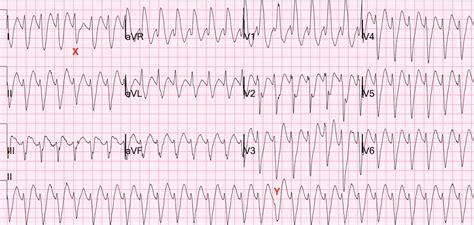 Dr. Smith's ECG Blog: Wide Complex Tachycardia -- VT, SVT, or A Fib ...