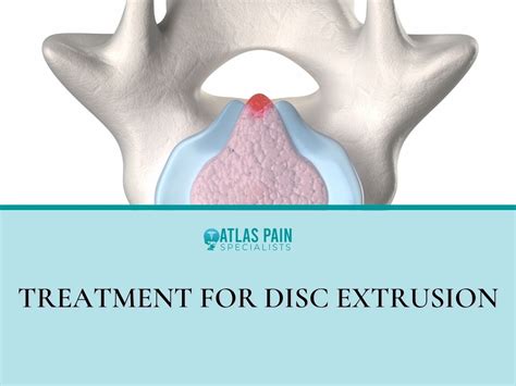 Image result for Foraminal Disc Extrusion