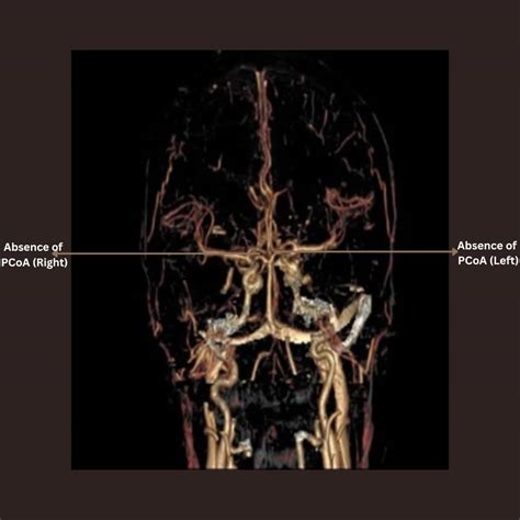 Cerebral Arterial Circle Circle Of Willis Medical Images DSA Of The