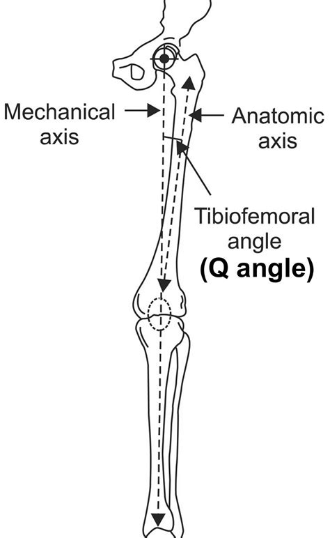 Genu Valgum Q Angle