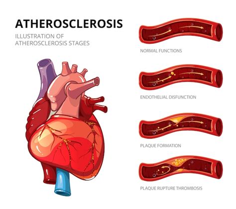 Atherosclerosis. fibrous plaque formation. medical human, health ...