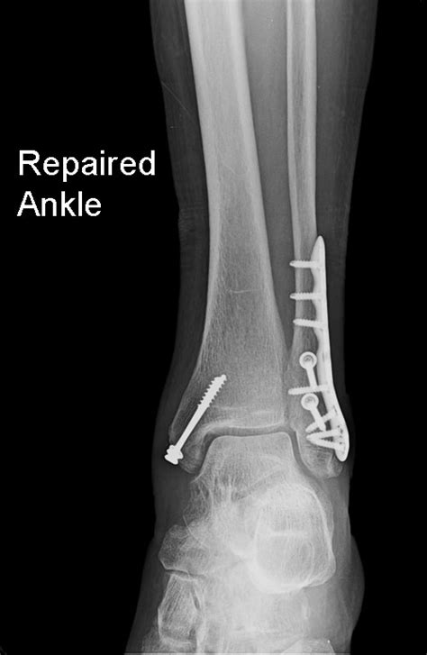 Ankle-fracture-fixation – Dr. John Skedros