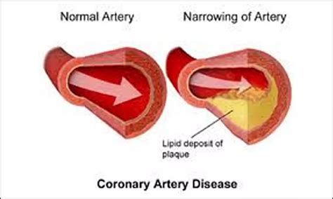 Low vaspin levels linked to increased coronary artery disease