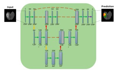 Image result for Tumor Segmentation Using Python