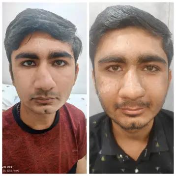 Gynecomastia Surgery