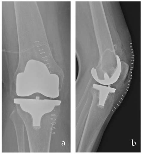 Medial Congruent and Medial Pivot Inserts in Total Knee Arthroplasty: A ...