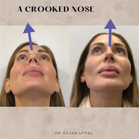 Fixing a Crooked Nose - Rajan Uppal