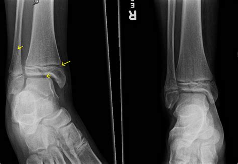 Triplane ankle fractures