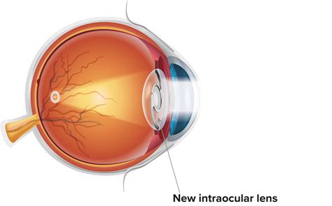 Eye Lens Replacement